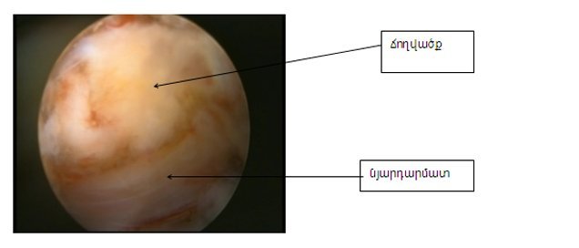 ճողվածք